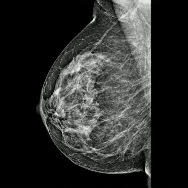 Traditional Mammography View